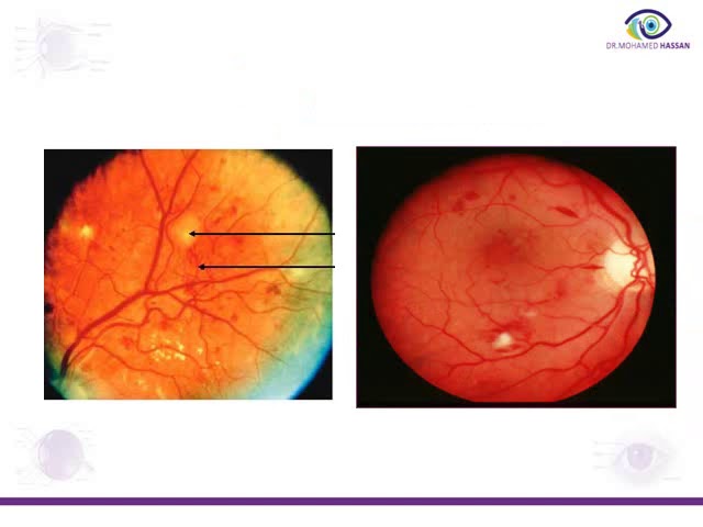 Diabetic Retinopathy from A to Z - Diabetic.Live